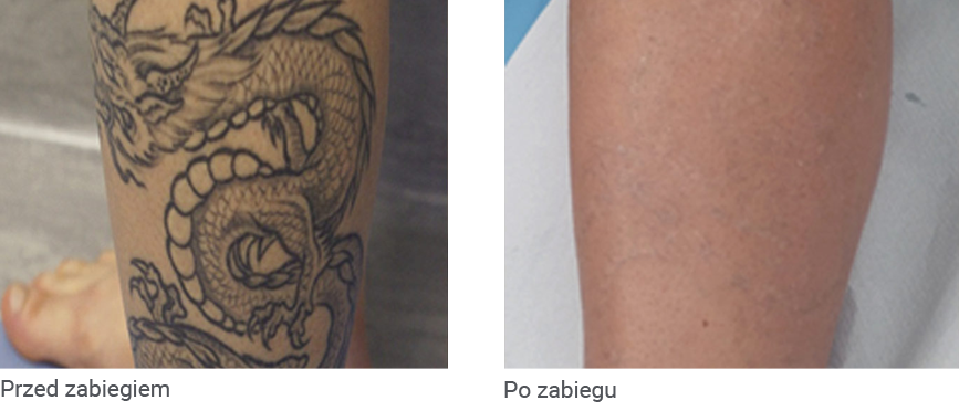 Likwidacja tatuażu